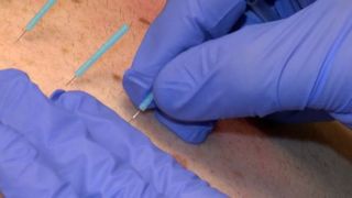  Dry needling and chiropractic care offered at Hammond-Henry Hospital