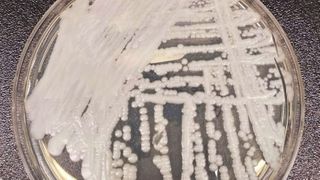 Superbug hits Iowa, Illinois, other states: Here's where the deadly fungus is spreading