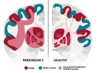 This complex brain network may explain many of Parkinson's stranger symptoms