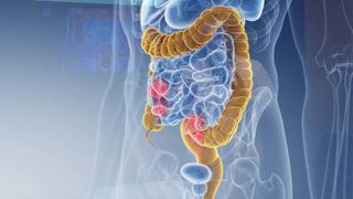  More young adults being diagnosed with colon cancer including in the QCA