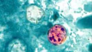 Parasitic illness cases are spiking: The symptoms to watch for
