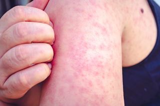 Officials monitor potential exposures after Iowa's first measles case of 2026