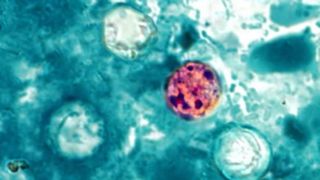  Iowa cases may be tied to national outbreak of cyclosporiasis