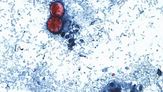 US cyclosporiasis cases on the rise