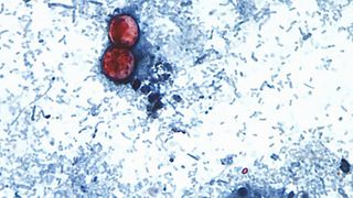  Cyclospora outbreak: More than 270 cases in over half of Iowa’s counties