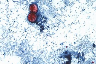Nearly 30 new cases of cyclosporiasis confirmed in Iowa