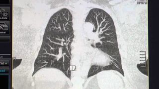 New robotic procedure to test for lung cancer comes to Galesburg