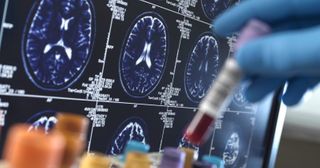 FDA approves new blood test for Alzheimer’s disease